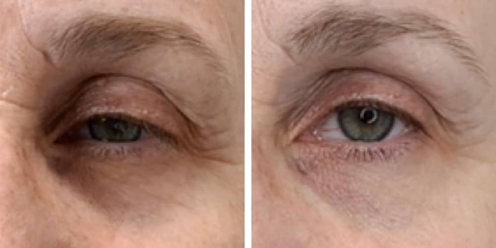 Before and After eye-01